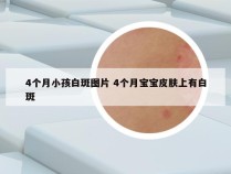 4个月小孩白斑图片 4个月宝宝皮肤上有白斑