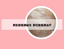 掌跎脓疱病秘方 掌砣脓疱病治疗