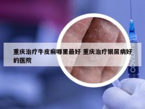 重庆治疗牛皮癣哪里最好 重庆治疗银屑病好的医院