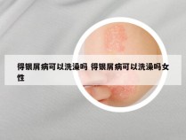 得银屑病可以洗澡吗 得银屑病可以洗澡吗女性