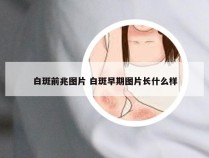 白斑前兆图片 白斑早期图片长什么样