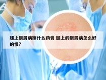 腿上银屑病擦什么药膏 腿上的银屑病怎么好的慢?