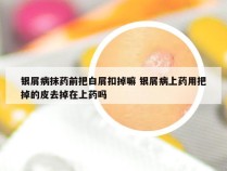 银屑病抹药前把白屑扣掉嘛 银屑病上药用把掉的皮去掉在上药吗