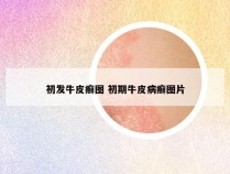 初发牛皮癣图 初期牛皮病癣图片