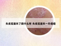 头皮后面长了藓什么样 头皮后面长一片痘痘