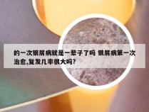 的一次银屑病就是一辈子了吗 银屑病第一次治愈,复发几率很大吗?