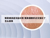 银屑病消退又起红斑 银屑病刚好点又变红了怎么回事