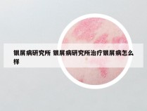 银屑病研究所 银屑病研究所治疗银屑病怎么样