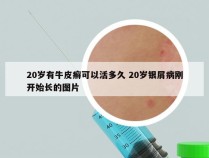 20岁有牛皮癣可以活多久 20岁银屑病刚开始长的图片