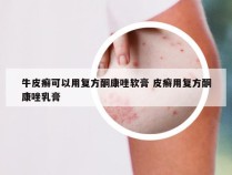 牛皮癣可以用复方酮康唑软膏 皮癣用复方酮康唑乳膏