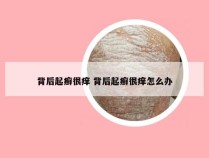 背后起癣很痒 背后起癣很痒怎么办