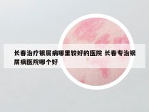 长春治疗银屑病哪里较好的医院 长春专治银屑病医院哪个好