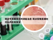 斑点牛皮癣多长时间能治愈 斑点型银屑病吃什么药比较安全