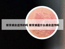 银宵病会遗传的吗 银宵病是什么病会遗传吗