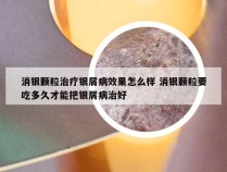 消银颗粒治疗银屑病效果怎么样 消银颗粒要吃多久才能把银屑病治好