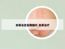 皮癣治愈后期图片 皮癣治疗