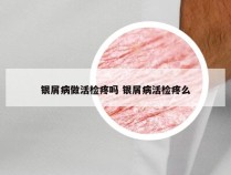 银屑病做活检疼吗 银屑病活检疼么