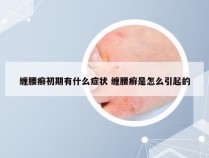 缠腰癣初期有什么症状 缠腰癣是怎么引起的