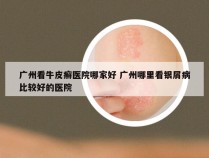 广州看牛皮癣医院哪家好 广州哪里看银屑病比较好的医院