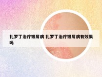 扎罗丁治疗银屑病 扎罗丁治疗银屑病有效果吗