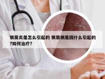 银屑炎是怎么引起的 银屑病是因什么引起的?如何治疗?