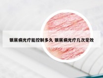 银屑病光疗能控制多久 银屑病光疗几次见效