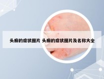 头癣的症状图片 头癣的症状图片及名称大全