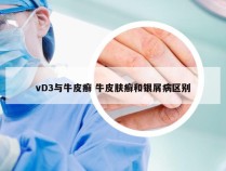 vD3与牛皮癣 牛皮肤癣和银屑病区别