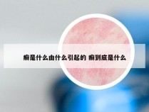 癣是什么由什么引起的 癣到底是什么