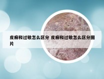 皮癣和过敏怎么区分 皮癣和过敏怎么区分图片