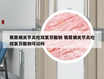 银屑病关节炎吃双氯芬酸钠 银屑病关节炎吃双氯芬酸钠可以吗