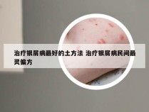 治疗银屑病最好的土方法 治疗银屑病民间最灵偏方