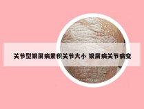 关节型银屑病累积关节大小 银屑病关节病变