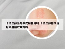 卡泊三醇治疗牛皮癣有用吗 卡泊三醇搽剂治疗银屑病效果好吗