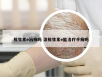 维生素e治癣吗 涂维生素e能治疗手癣吗