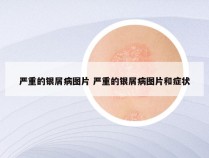 严重的银屑病图片 严重的银屑病图片和症状