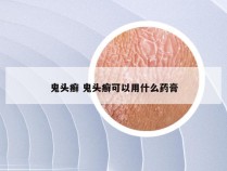 鬼头癣 鬼头癣可以用什么药膏