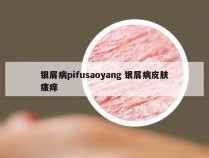 银屑病pifusaoyang 银屑病皮肤瘙痒