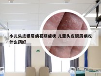 小儿头皮银屑病初期症状 儿童头皮银屑病吃什么药好