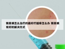 银屑病怎么治疗的最好疗越痒怎么办 银屑病有好的解决方式