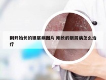 刚开始长的银屑病图片 刚长的银屑病怎么治疗