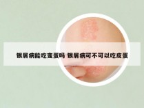 银屑病能吃变蛋吗 银屑病可不可以吃皮蛋