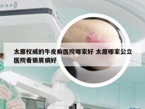 太原权威的牛皮癣医院哪家好 太原哪家公立医院看银屑病好