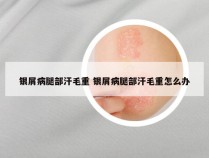 银屑病腿部汗毛重 银屑病腿部汗毛重怎么办