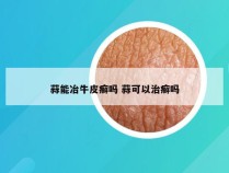 蒜能冶牛皮癣吗 蒜可以治癣吗