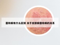 菌和癣有什么区别 关于皮肤癣菌和癣的关系