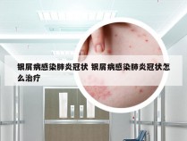 银屑病感染肺炎冠状 银屑病感染肺炎冠状怎么治疗