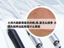 小孩大腿都像是长的癣,痒,是怎么回事 小孩大腿两边起癣是什么原因