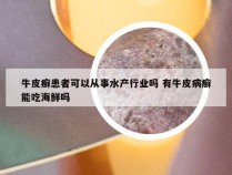 牛皮癣患者可以从事水产行业吗 有牛皮病癣能吃海鲜吗