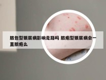 脓包型银屑病影响走路吗 脓疱型银屑病会一直脓疱么